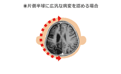 ●片側半球に広汎な病変を認める場合の図