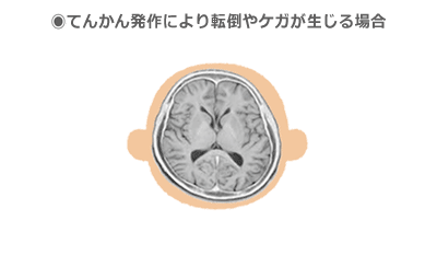●てんかん発作により転倒やけがが生じる場合の図