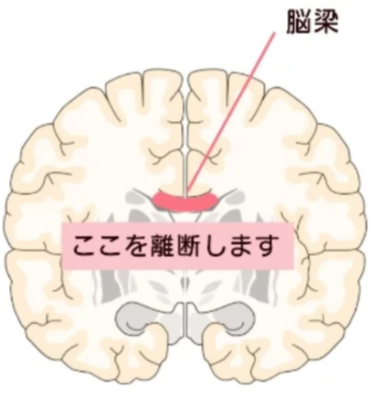 脳梁の位置の図