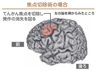 「焦点切除術の場合」
てんかん焦点を切除し、発作の消失を図る。左の脳を横から見たところの図