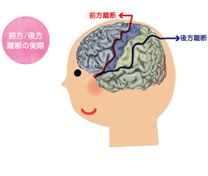 「前方／後方離断術の実際」の図