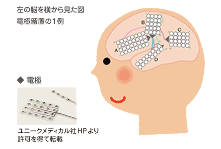 「左の脳を横からみた図」電極留意の1例の図