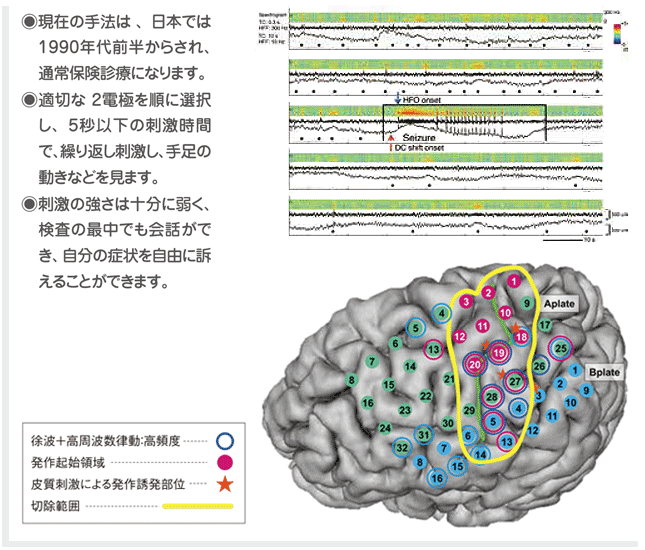 ●現代の手法は、日本では1990年代前半からされ、通常保険診療になります。●適切な2電極を順に選択肢、5秒以下の刺激時間で、繰り返し刺激し、手足の動きなどを見ます。●刺激の強さは十分に弱く、検査の最中でも会話ができ、自分の症状を自由に訴えることができます。の図