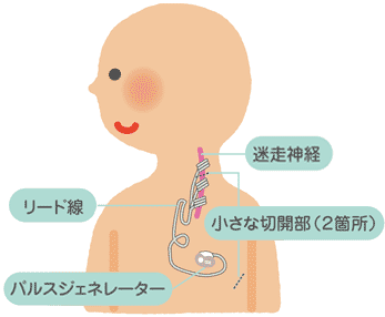 迷走神経刺激療法 | 外科的治療 | WePiLi てんかんアドバンスド